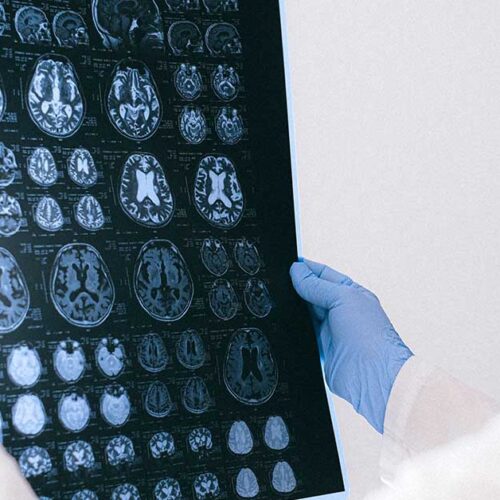 Kinetoterapia și accidentul vascular cerebral